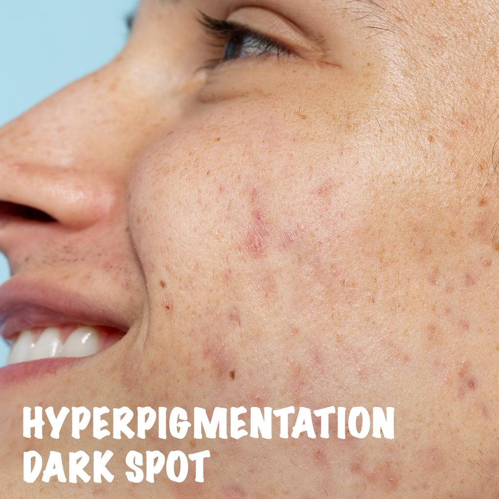 Hyperpigmentation  Dark Spot